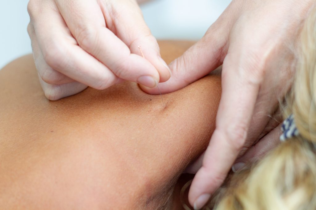 Foto Dry Needling behandeling